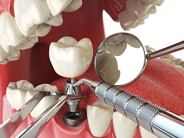 Best Broken or Cracked Tooth Emergency Dentist in Walnut, IL